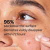 Deep Blemish Microdarts, Below-the-Surface Pimple Patches, 9 Ct